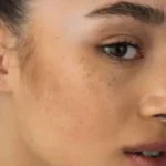 علت تیرگی پوست صورت در زنان + پیشگیری و درمان